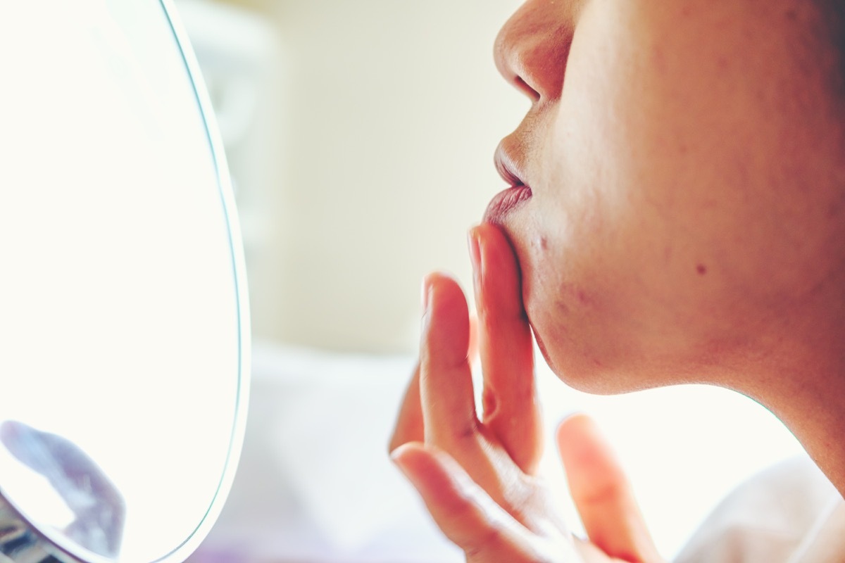 Close up Girl applying aloe gel to problematic skin with acne scars, Health care products at medical industry. girl gently touches her forehead with pimples on her skin.