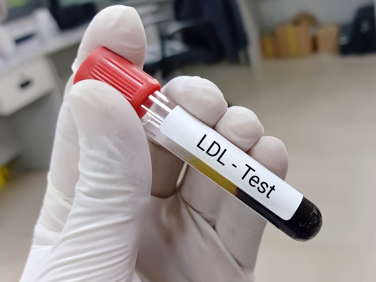 Cholesterol Test