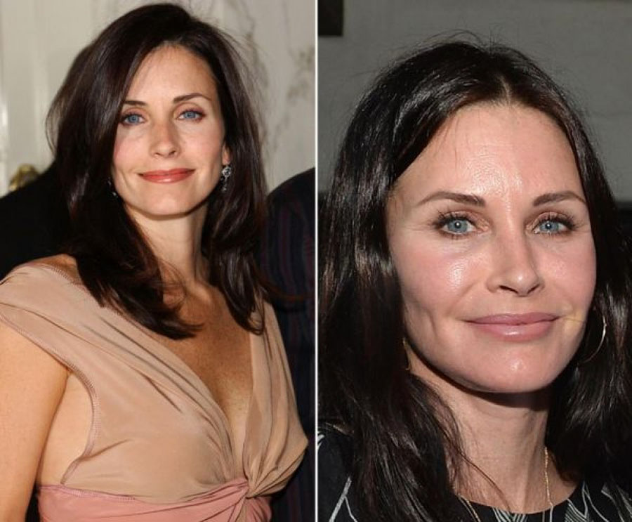 gorgeous-stars-before-and-after-botox-01