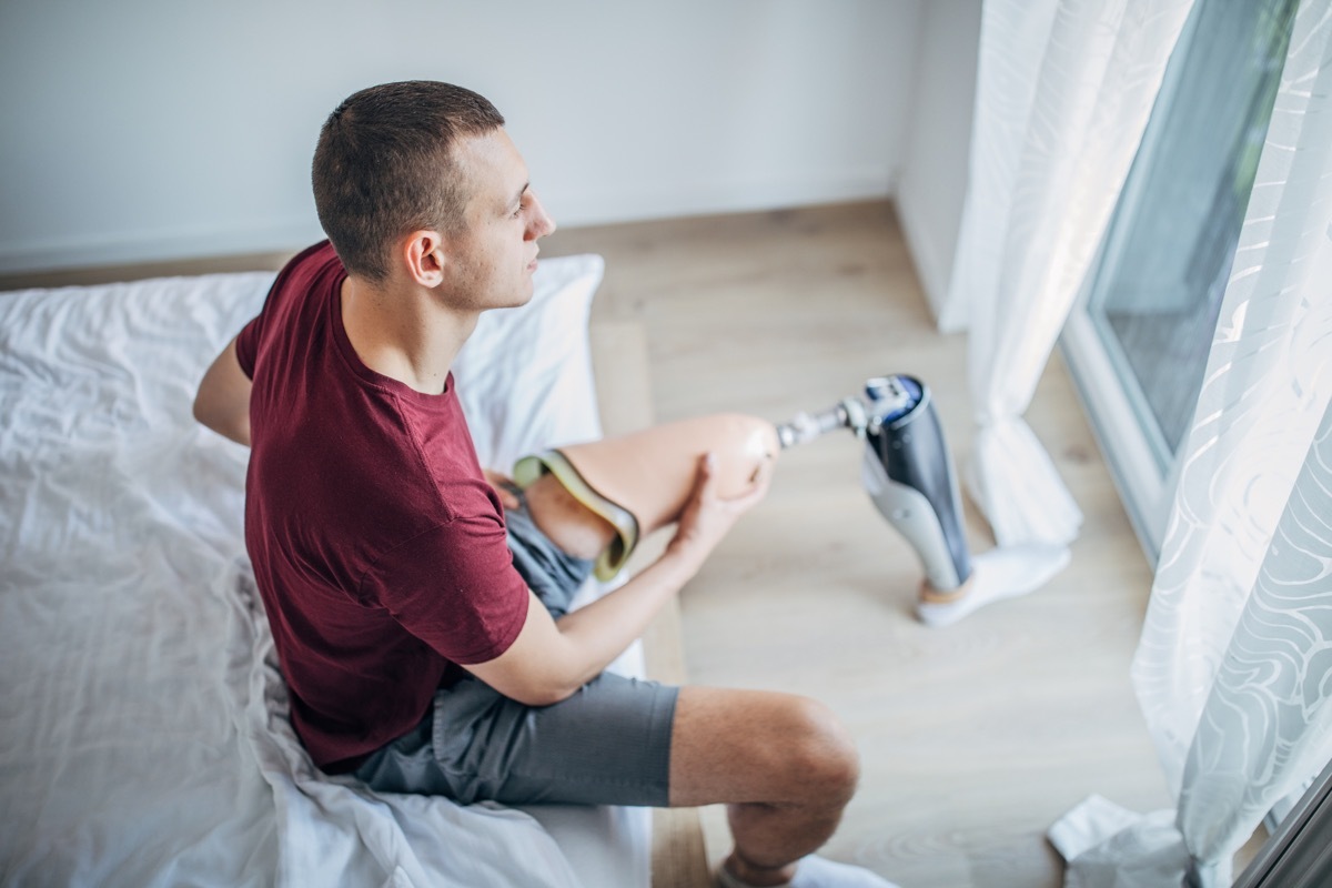 Young man with amputee leg putting on his prostheses leg