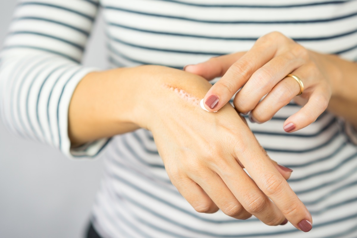 heat burn wound on her hand.