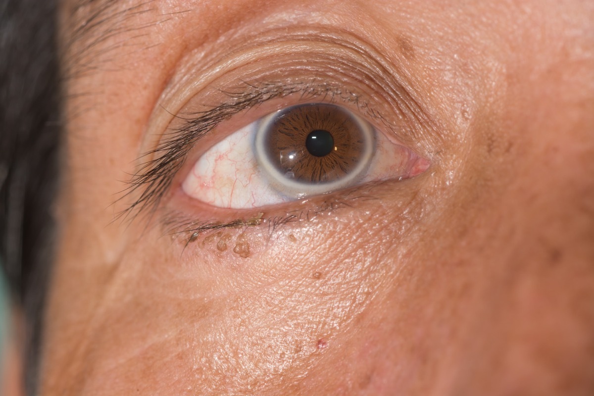 close up of arcus senilis during ophthalmic examination. - Image