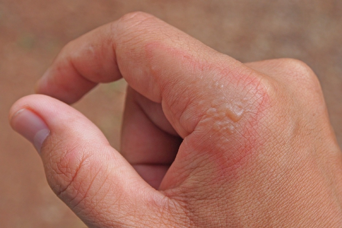 impetigo on hand, contagious conditions