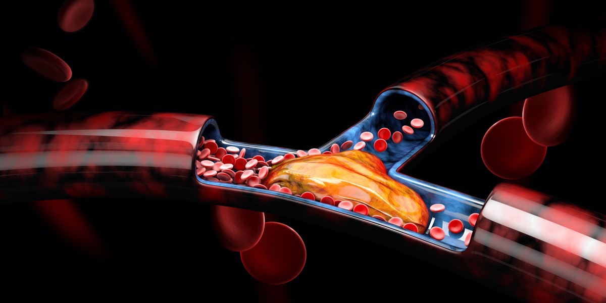 3d Illustration of Deep Vein Thrombosis or Blood Clots, Embolism.