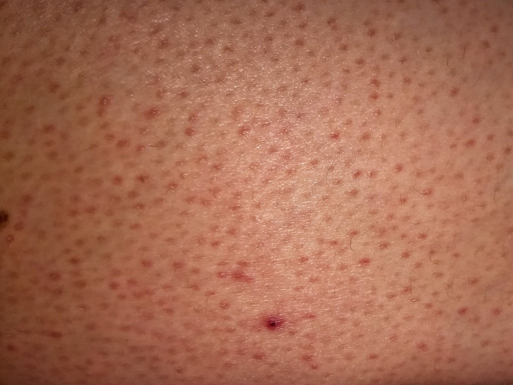 bumps on skin