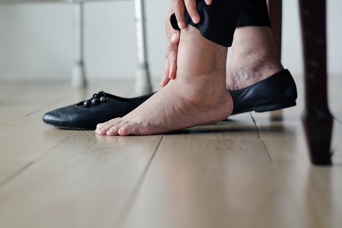 Woman with swollen ankle foot