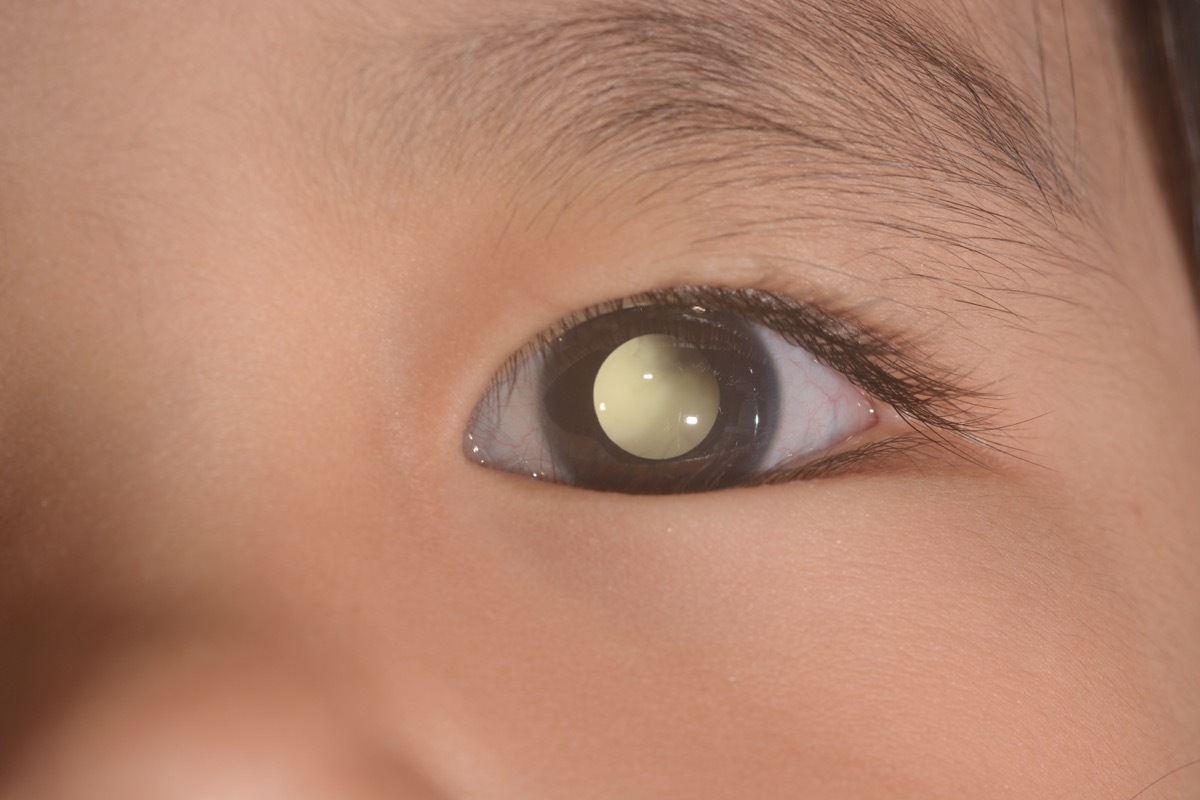 Retinoblastoma