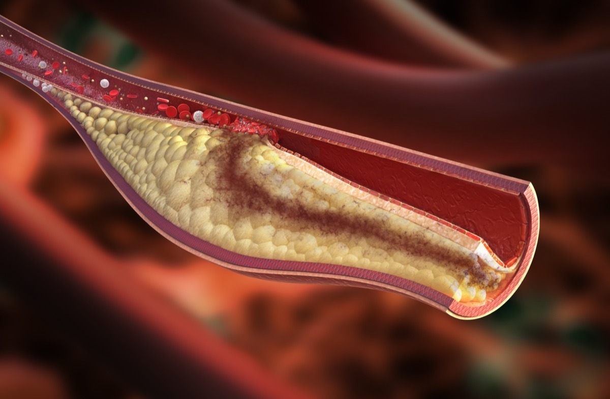 High detail image of unstable atherosclerotic plaque condition