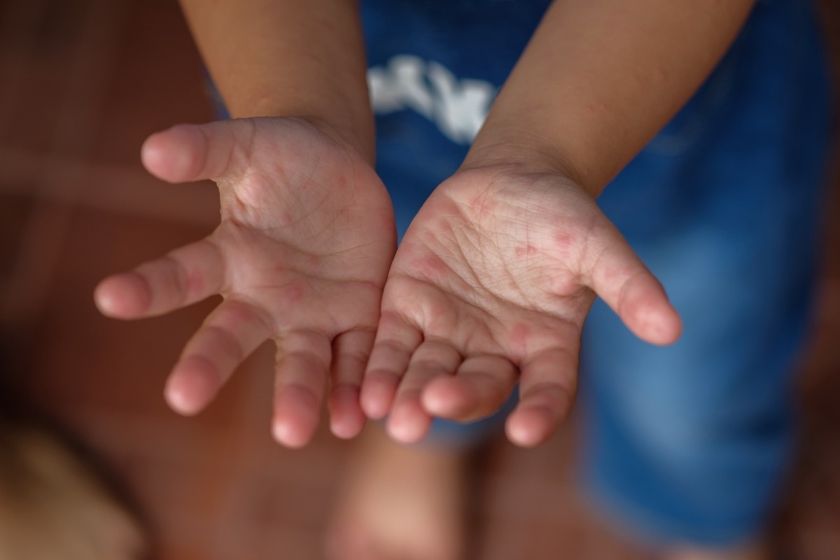 hand foot mouth disease, classroom germs